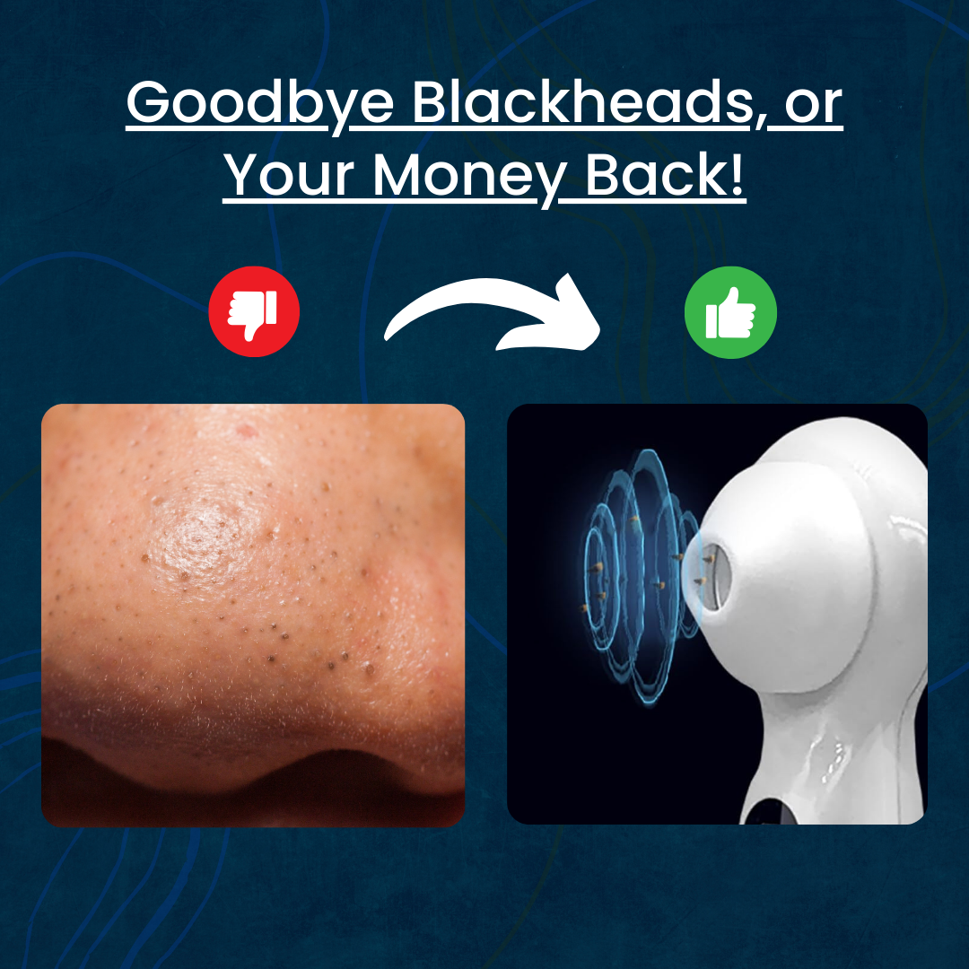 DermaPure™ - Blackhead remover