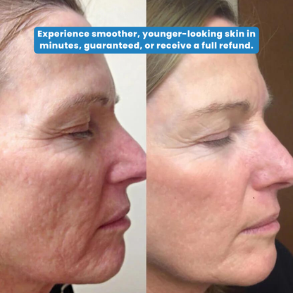 GlowWave Pro™ - The #1 microneedling